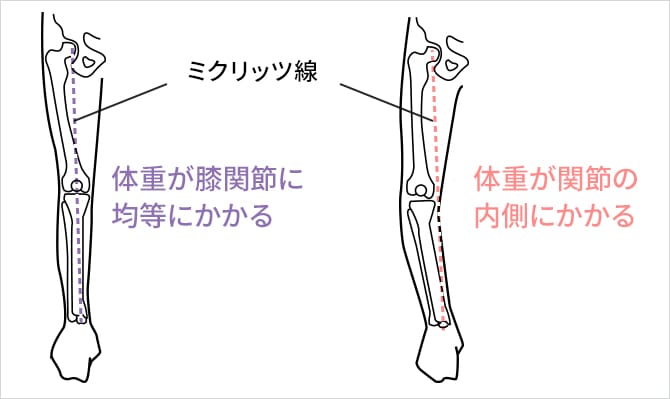 変形性膝関節症のO脚と筋肉の関係