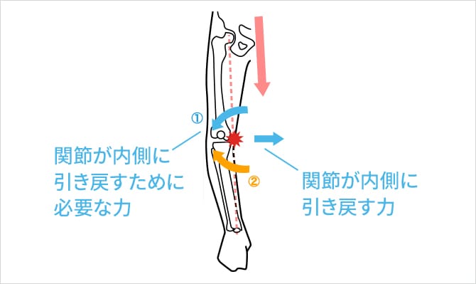 変形性膝関節症のO脚と筋肉の関係